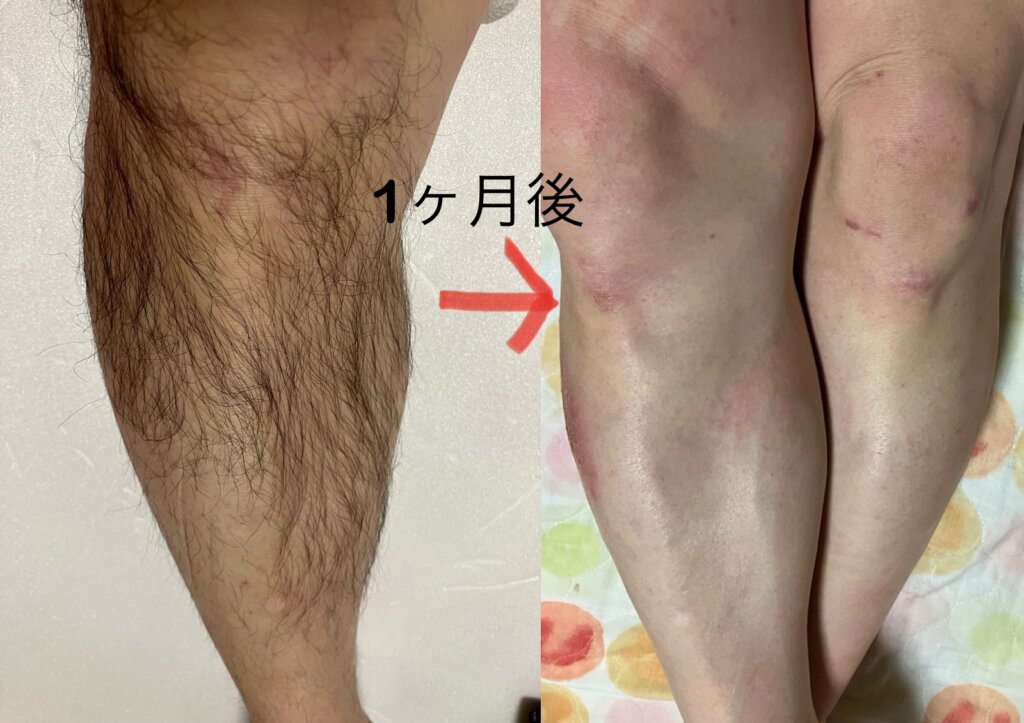 ケノン1か月使って1か月放置してみた!脚、腕、脇、VIOはツルツルに♪ツルツルすぎて温泉に行った時恥ずかしい///髭だけは元気