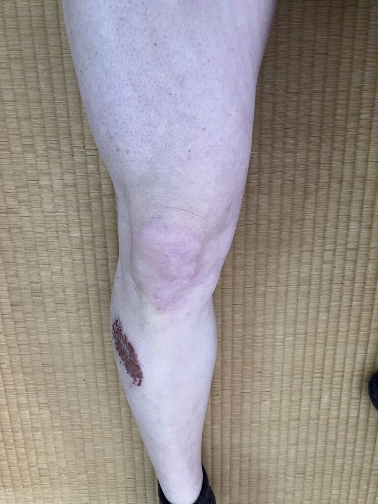 傷口