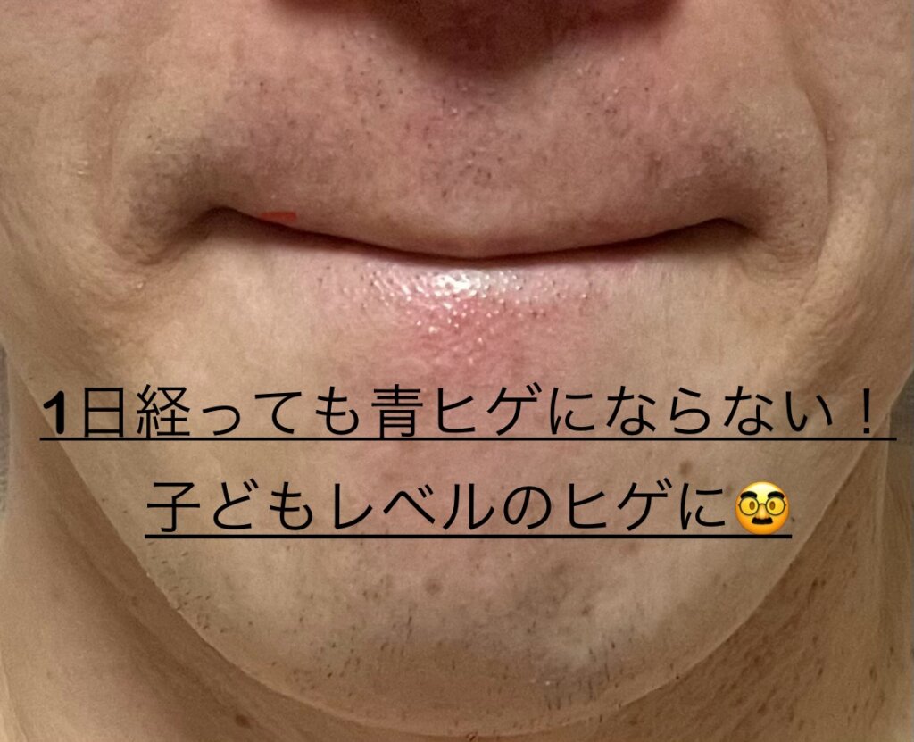 髭にも1か月で40%効果あり!あんなに濃かった青髭が子供のヒゲになった